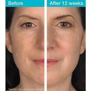 spot corrector correctors correcting